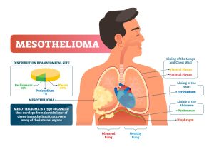 Mesothelioma